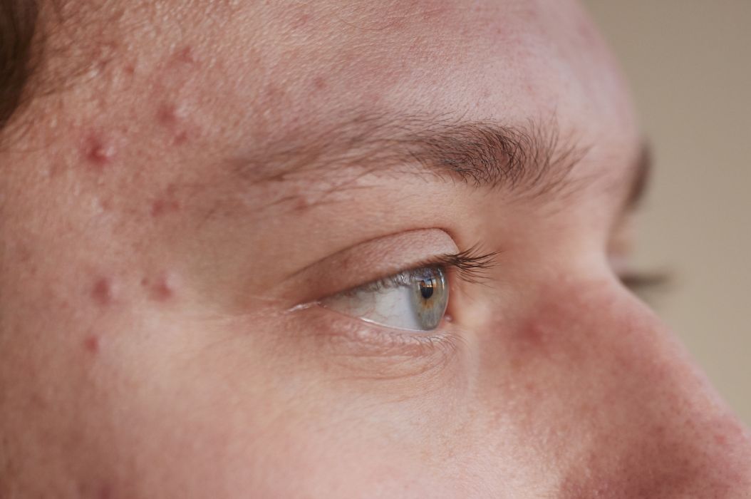 Adult Acne